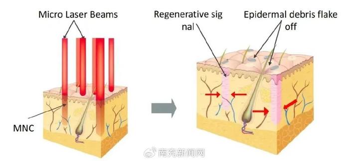 安全性高:这种激光技术对皮肤非常温和,不会气化皮肤,痛感弱,对皮肤的