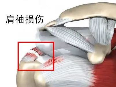 肩袖又叫旋转袖,是包裹在肱骨头周围的一组肌腱复合体,主要协助肩关节