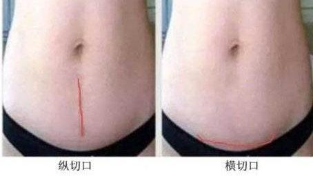 孕妈剖腹产选择横切还是竖切的好？你真的选对了么？