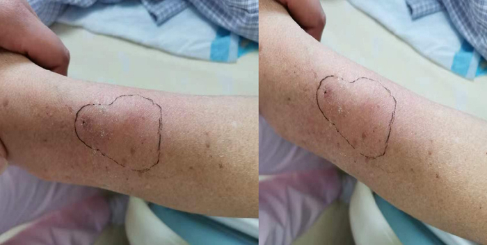 拔针后6小时发生迟发性静脉炎,输注这种药物需警惕!