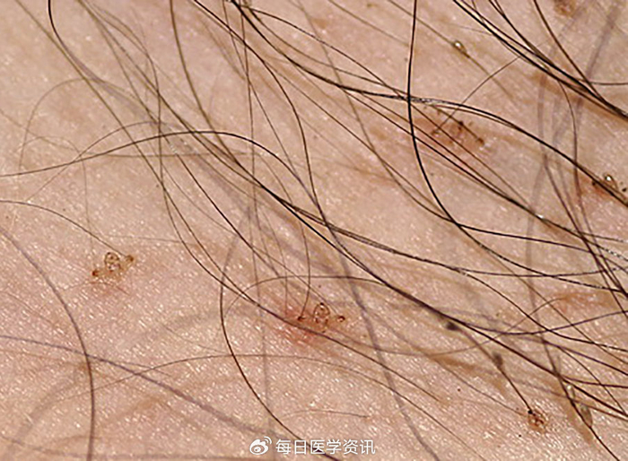 53.阴虱病
