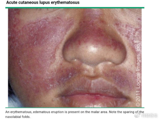 三,红斑狼疮是什么样的呢?