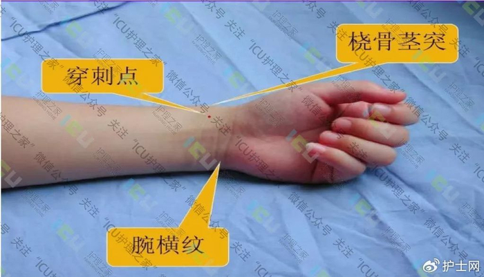 桡动脉穿刺部位:桡骨茎突内侧1cm与横纹肌上1cm交界处,即搏动最明显处