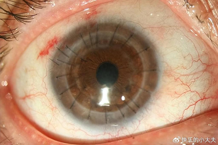 白内障术后 3 个月很关键!做好日常护理!|白内障|晶状体|手术_新浪新
