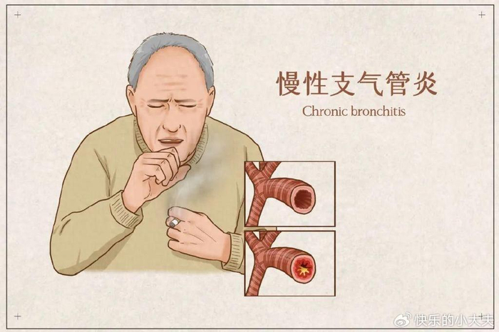 远离慢性支气管炎,这些错误认知不要犯！做好正确治疗！|感染|疾病|咳嗽|呼吸道感染|反复呼吸道感染_新浪新闻