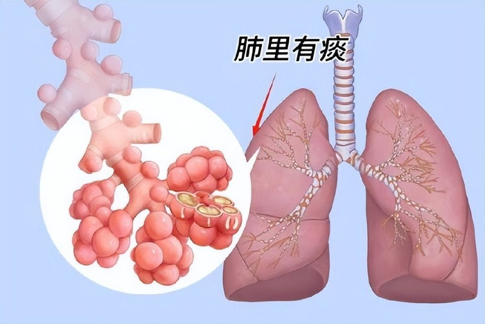嗓子里总有痰,痰多吐不完?中医教你3招,轻松切断“生痰之源”|肺癌|慢性支气管炎|痰液_新浪新闻