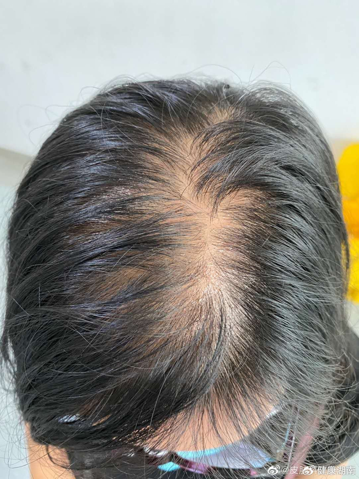 这种风湿病青睐"妙龄女子"|系统性红斑狼疮|狼疮|红点_新浪新闻