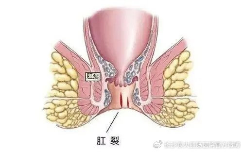 医疗|肛裂|肛门_新浪新闻