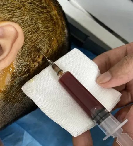 "护士,为什么纱布要勒得那么紧?"|积液|引流管|开颅_新浪新闻