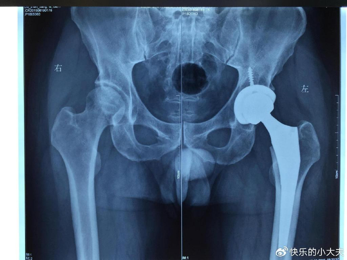 股骨头坏死对身体危害不小,出现这6个症状,及时就医!