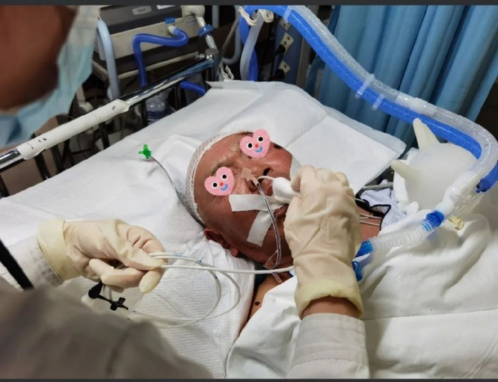 盲插鼻空肠管也可"顺藤摸瓜"?这个小技巧值得icu护士一看