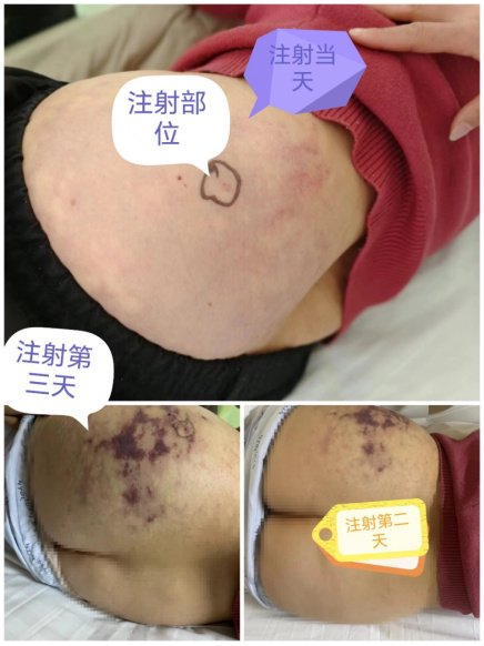 转发提醒所有医护!|苄星青霉素|针头|患者_新浪新闻