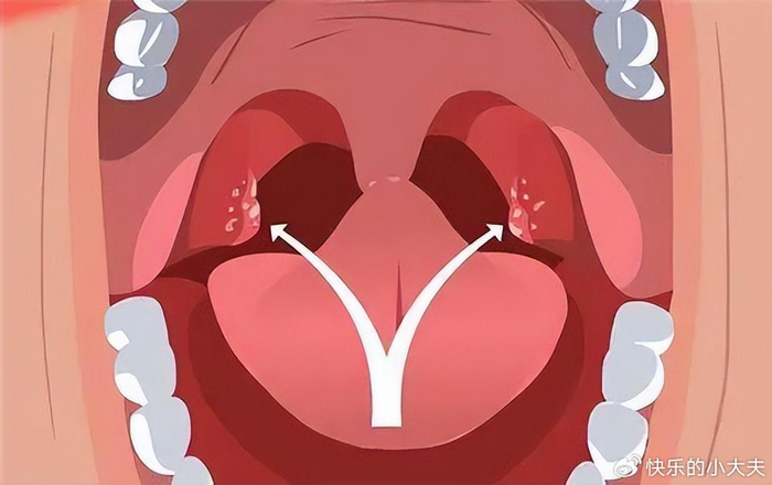 扁桃体肿大的症状