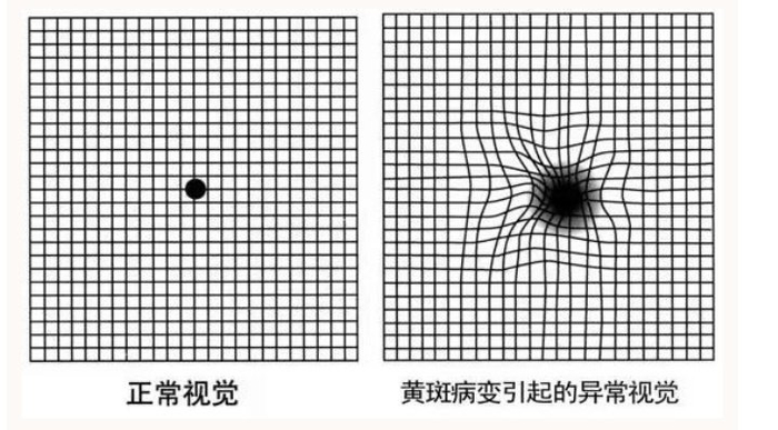 中老年人看"歪"直线 重庆普瑞眼科专家提醒警惕黄斑变性致盲眼病
