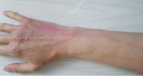 胺碘酮发生输液反应(静脉炎)的预防及处理措施|胺碘酮|静脉炎|血管