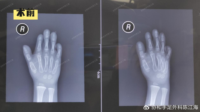 术前x光片术后1年,妈妈说:拿东西不影响,活动也挺好术后1个多月,孩子