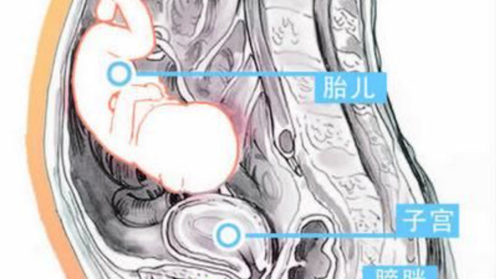 什么是腹腔妊娠？