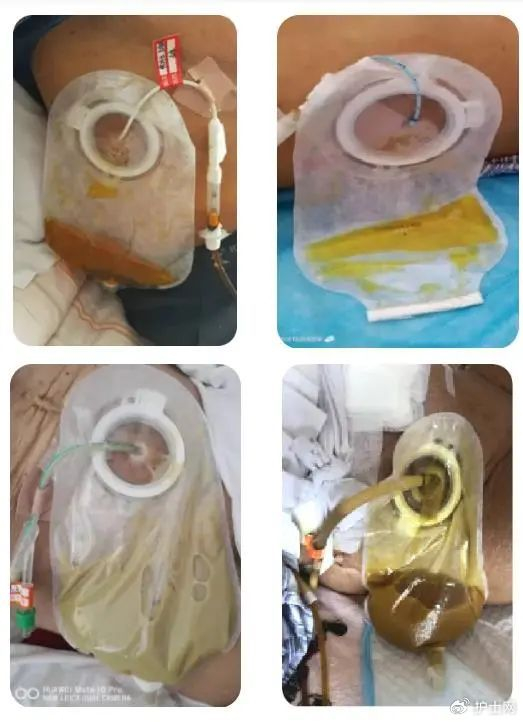 如何巧用造口袋|外科_新浪新闻