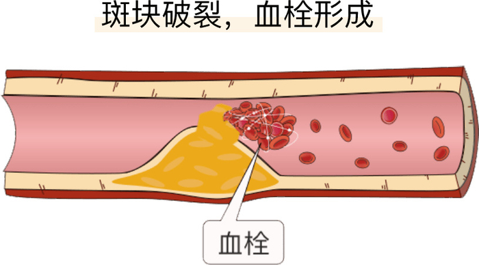 经常提到血栓,血栓到底是什么?有哪些症状?如何治疗?|血栓脱落|深静脉血栓|静脉血栓|动脉血栓|血管_新浪新闻