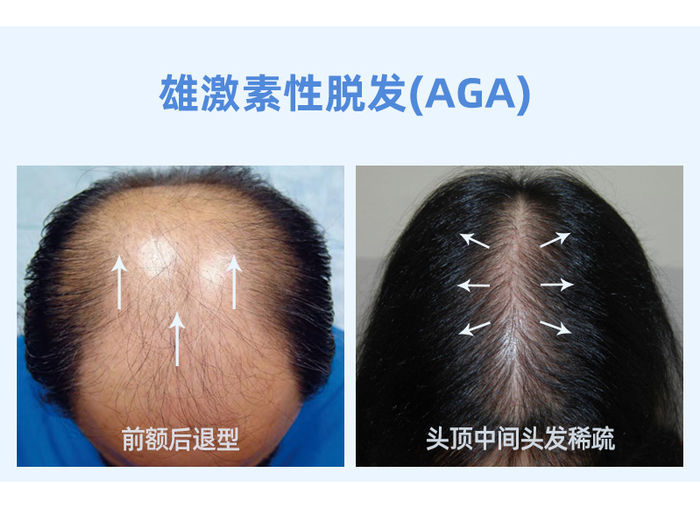 常见的脱发类型有哪些?应该怎样治疗?