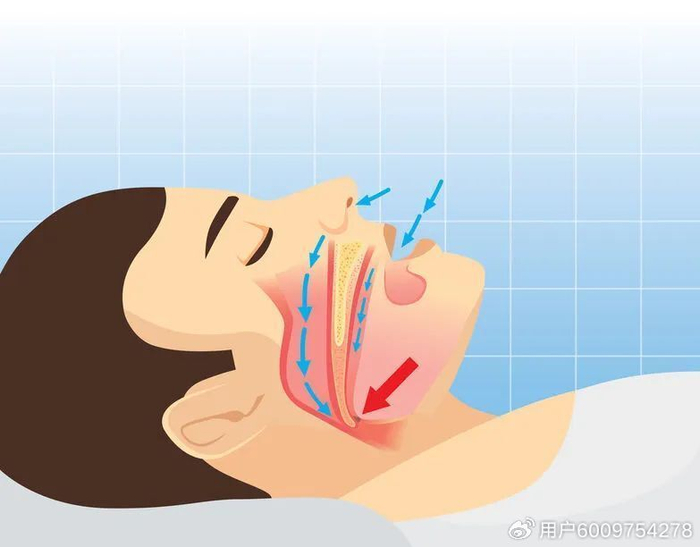 打鼾,人体潜在的健康杀手