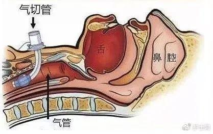 關於臨床重症患者氣管切開後的相關護理,這10步你都做到了嗎?|感染_新