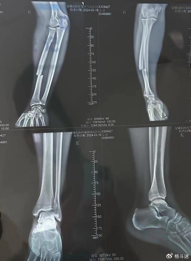 手臂骨折真实图片