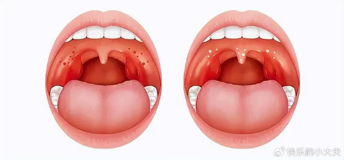 扁桃体肿大的治疗方法