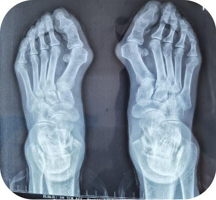 陕西中医药大学附属医院:夏季即将来临,告别大脚骨,秀出足部美|附属