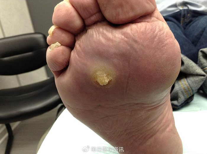 71.鸡眼
