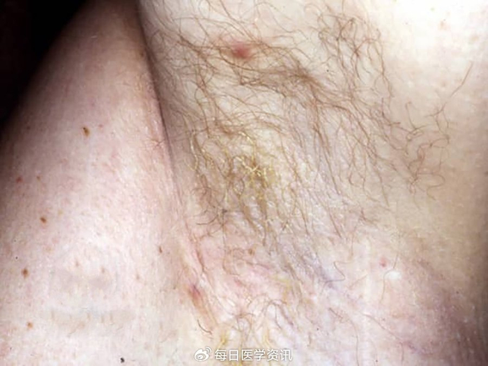 30.腋毛癣