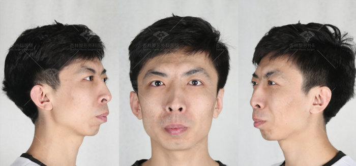6种嘴凸类型大揭秘,快来看看你属于哪一种!|手术|骨性|凸嘴矫正|改脸型|颌面部_新浪新闻