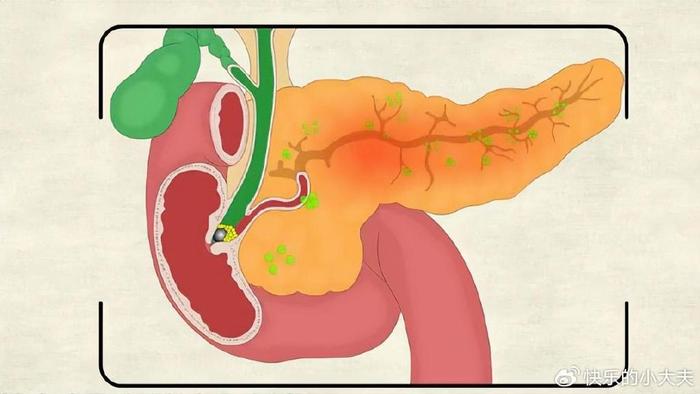 小心急性胰腺炎 医生提醒 9个症状不要忽视