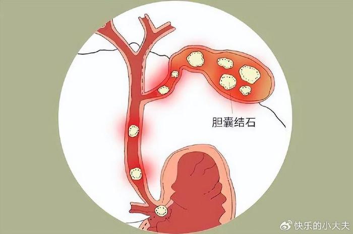 胆结石在身体的位置图图片