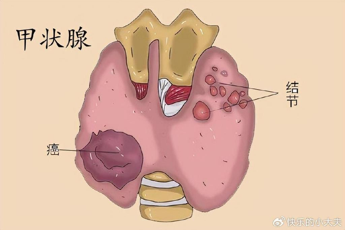 什么是甲状腺癌