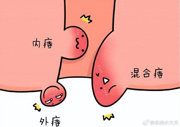 痔疮|肛门|症状_新浪新闻