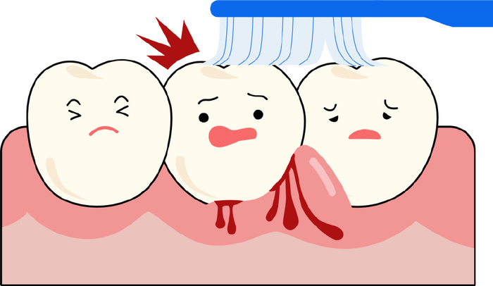 牙龈肿痛出血的原因