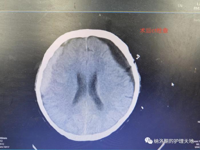 脑硬膜下血肿图片