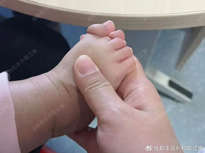 可爱宝宝手脚被羊膜束带缠上,指头挤成一团,还能分开5指吗|束带|植皮