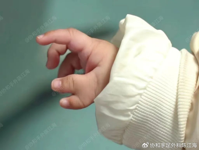 宝宝天生六指,像个"蟹钳"该怎么办?