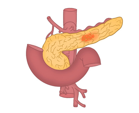 胰腺癌如何早期发现