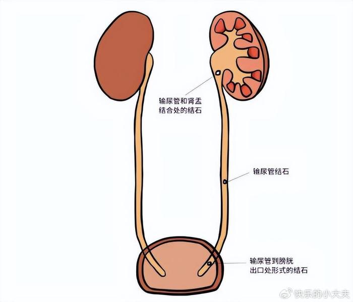 输尿管结石了？怎么办？如何治疗与预防？|冲击波|结石|输尿管结石_新浪新闻