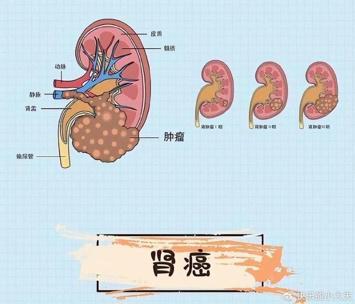 肾癌会遗传吗图片