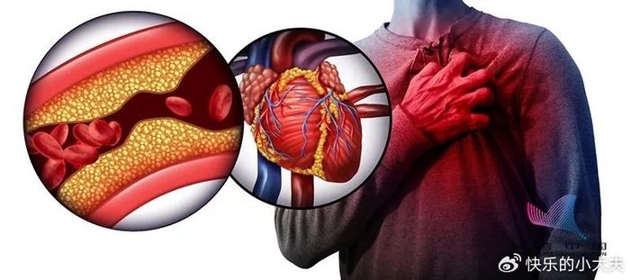 心肌缺血的诱发因素有哪些?