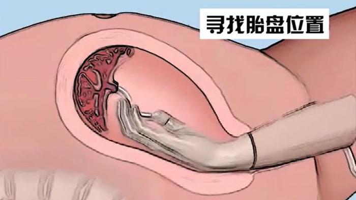 手剥胎盘并非医生“残忍”，产科主任：三类妈妈最容易遭罪