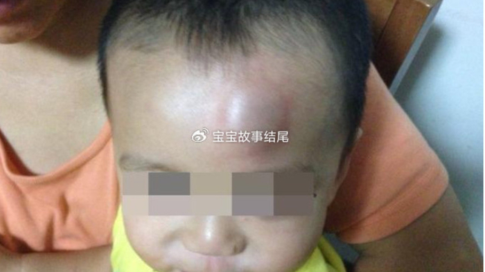 62天婴儿坠床，突发精神萎靡，妈妈应急做法，被医生陈赞