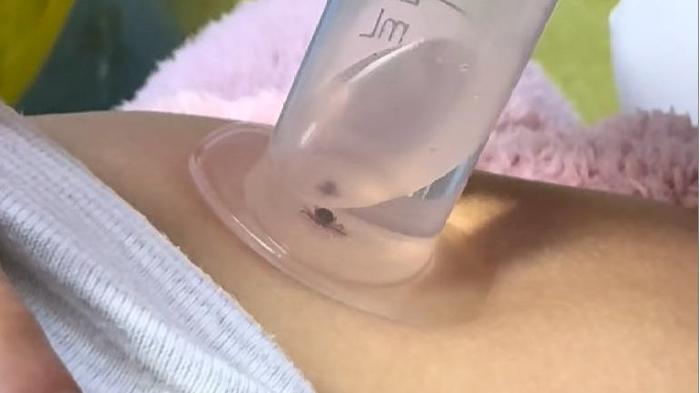 孩子被蜱虫咬阿婆手抠无果，妈妈一招救娃，网友：姨夫被蜱虫咬死