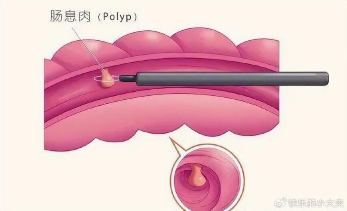 息肉卡通图片图片