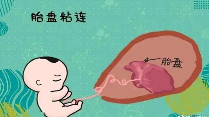 【原创科普】分娩中闻风色变的隐秘战斗——手剥胎盘