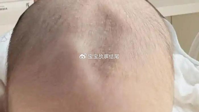 婴儿囟门“凹”和“凸”,有什么区别?暗示原因也不同